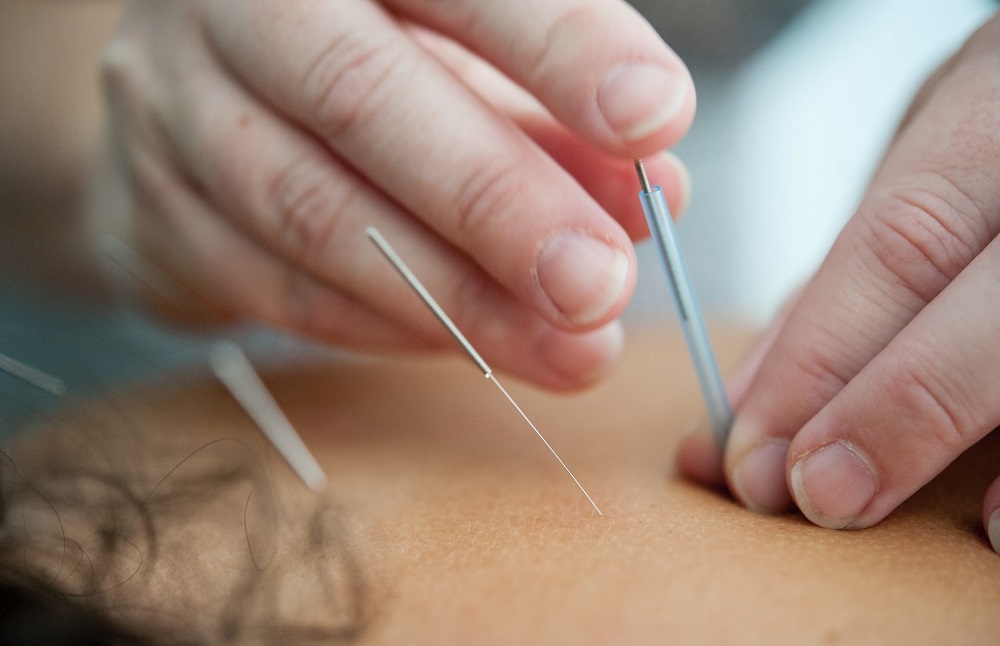 Needling Therapy in Williamsburg & North English